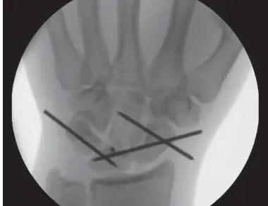 صورة توضيحية لـ خلع الرسغ الهلالي المحيط: دليل شامل للمرضى مع الأستاذ الدكتور محمد هطيف