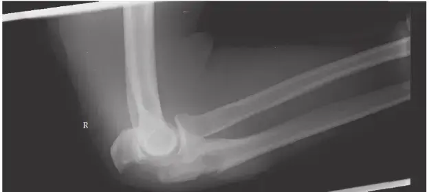 اكتشف: علاج كسور هضبة الظنبوب.. دليل التعافي!