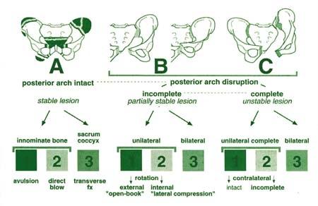 Pelvic Ring Fractures: Diagnosis, Treatment, and Prognosis