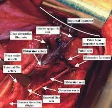 علاج كسور عظام الفخذ: دليلك الكامل للتشخيص والإدارة الطارئة