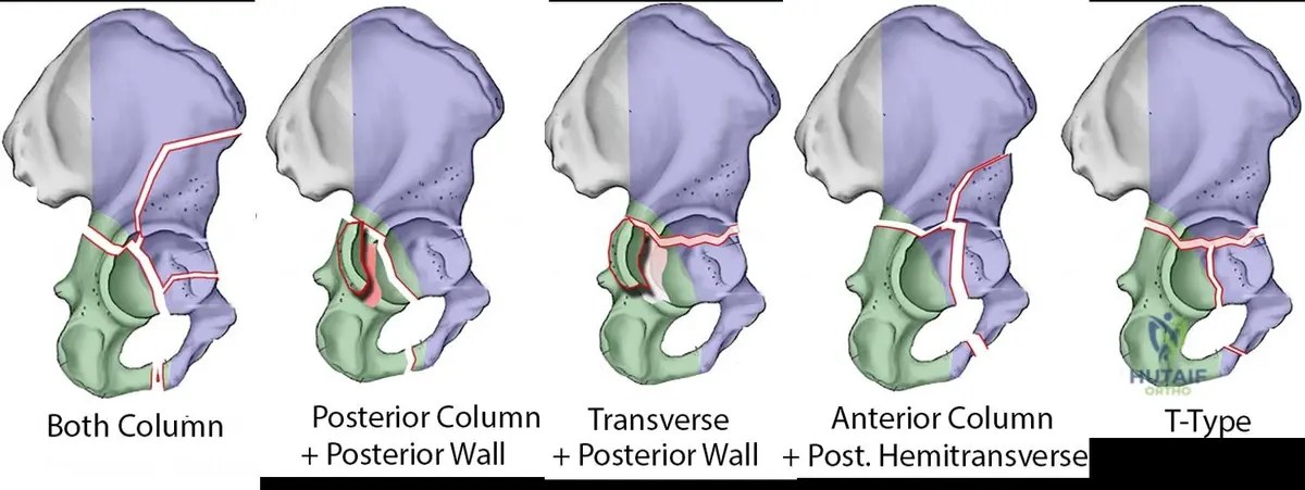 ![Judet and Letournel Classification \(Source: Hutaif Orthopedic Center\)