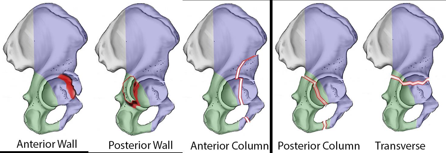 ![Judet and Letournel Classification \(Source: Hutaif Orthopedic Center\)