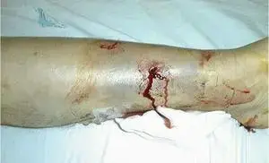 اكتشف اسرار ترميم مفصل الورك: حلول متقدمة للفشل الجراحي