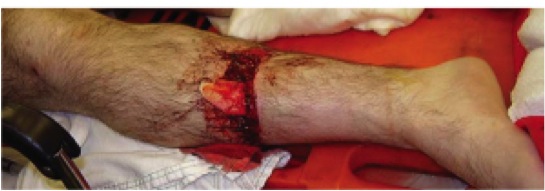 ![OTA Classification \(Source: Hutaif Orthopedic Center\)