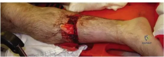 ![OTA Classification \(Source: Hutaif Orthopedic Center\)