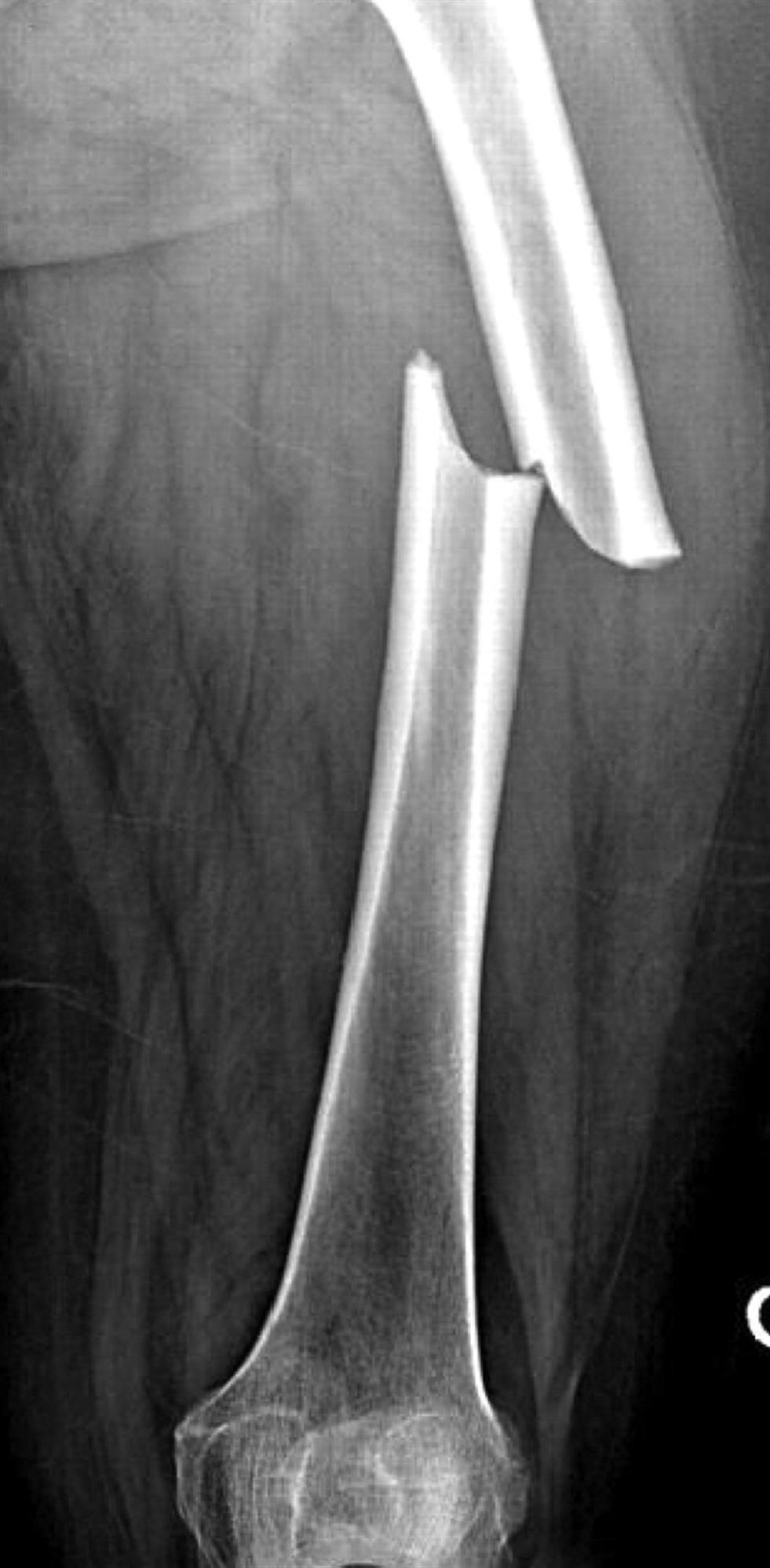 Biomechanics and Treatment of Femoral Shaft Fractures