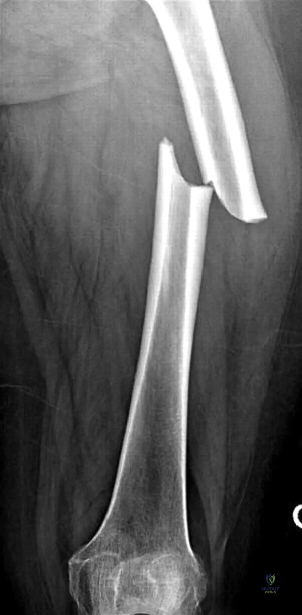 Navigating Femoral Shaft Fractures: Diagnosis to Successful Recovery