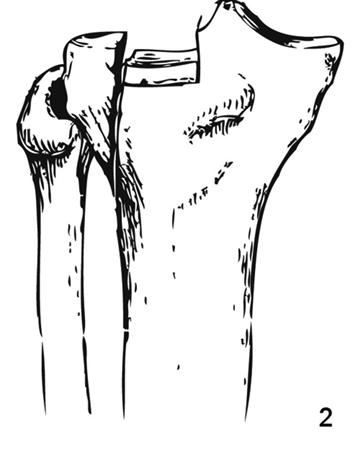 Tibial Plateau Fractures: Anatomy, Diagnosis, and Treatment