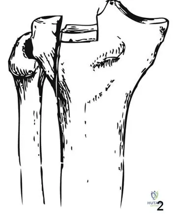 Tibial Plateau Fractures: Advanced Surgical Management, Epidemiology & Anatomy