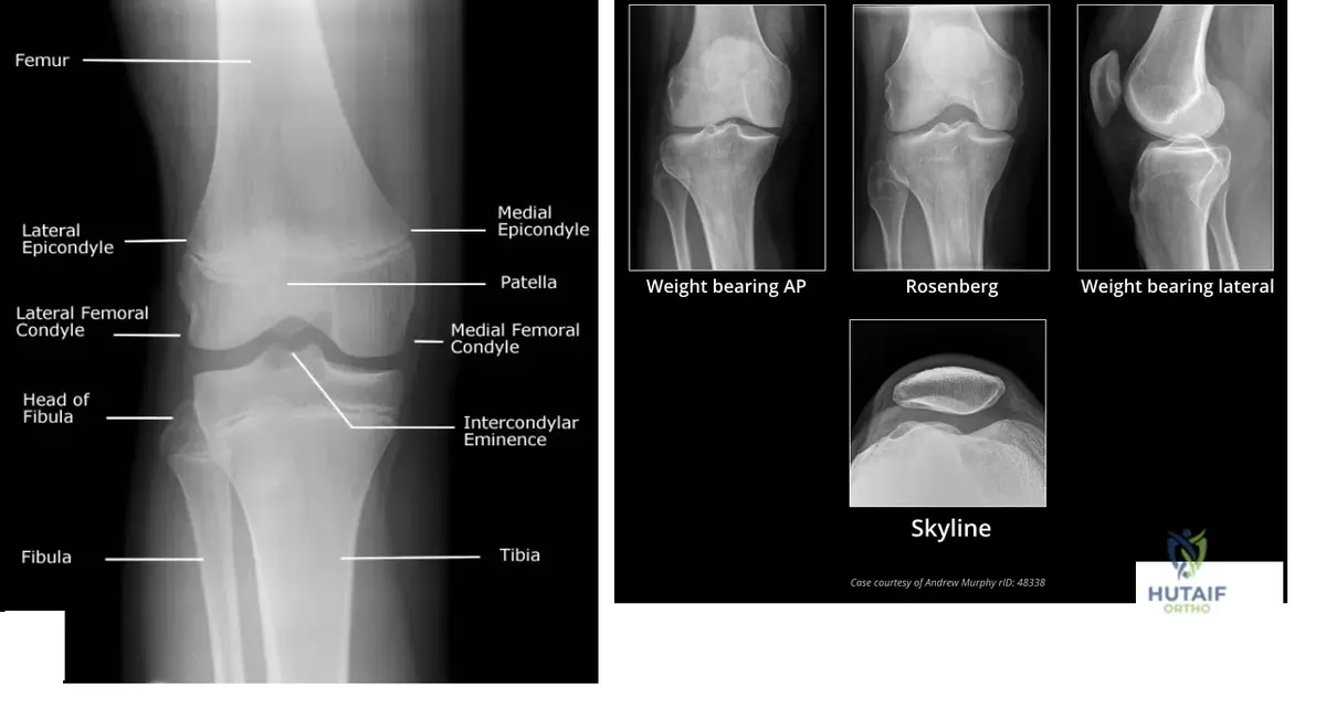 ![Tibial Plateau