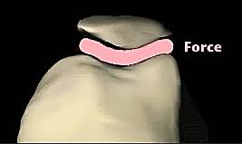 تلين عظمة الرضفة: إدارة آلام الركبة الخاصة بك