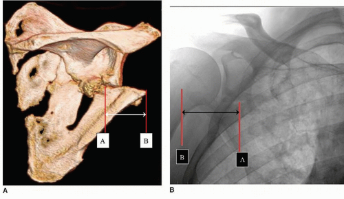 Scapula Fracture Image