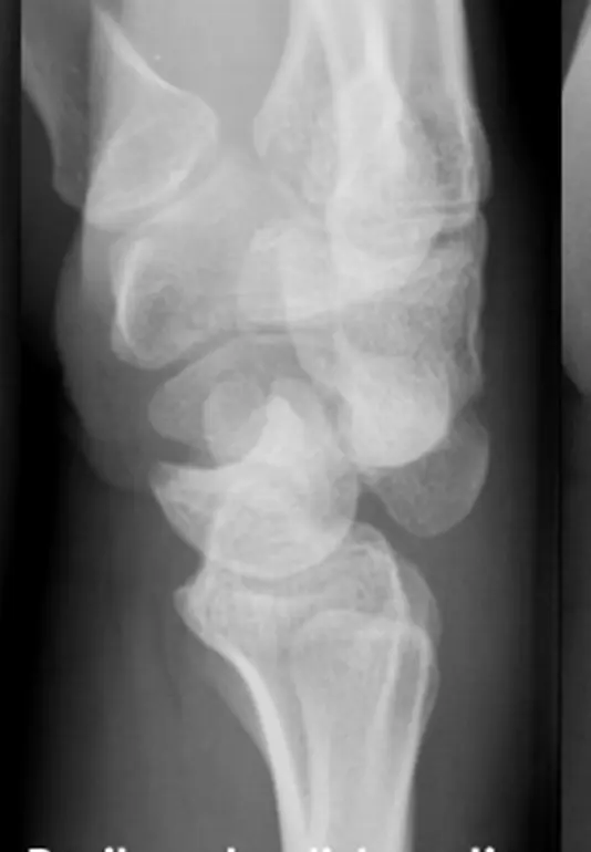 صورة توضيحية لـ خلع الرسغ المحيط بالعظم الهلالي: دليلك الشامل لاستعادة حركة يدك