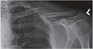 Radiograph of a displaced middle third clavicle fracture