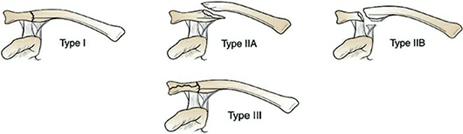 Classification of group II clavicle fractures