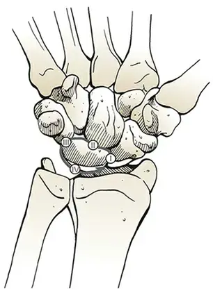 تحدي عظم الفخذ القريب المشوه: استبدال مفصل الورك بنجاح