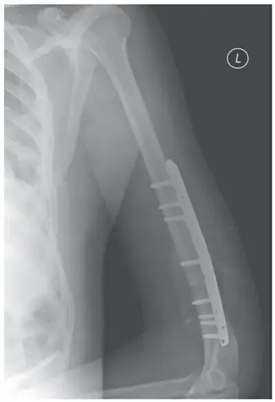 دليلك الشامل لإدارة شلل الأطفال العظمية: رؤى فعّالة