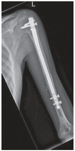 Intramedullary nail fixation of a humeral shaft fracture.
