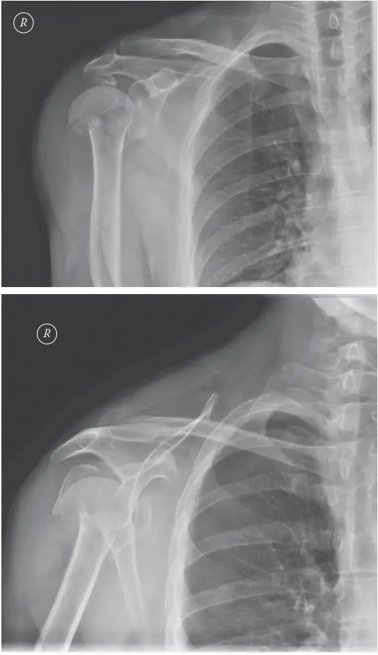 صورة توضيحية لـ كسر عظم العضد القريب: دليل شامل للعلاج والتعافي مع الأستاذ الدكتور محمد هطيف