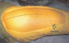 Fascial Incision and Retraction