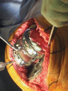 Illustration 55 for Posterior Stabilized Technique: Essential Insights for TKA Success