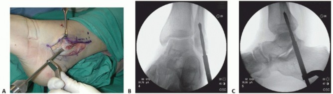 Illustration 33 for Beyond Primary Repair: Solutions for Peroneal Tendon Subluxation