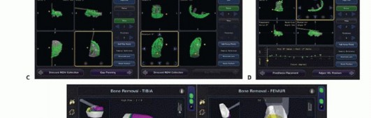 Illustration 22 for Unicondylar Knee Arthroplasty: Is This Your Solution to Knee Pain?