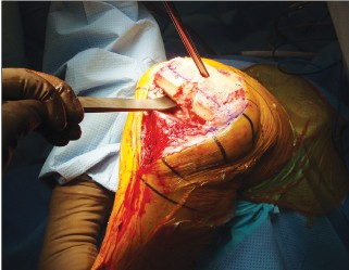 Illustration 6 for Posterior Cruciate Ligament-Retaining TKA: Navigating Pitfalls