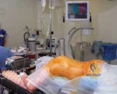 الدليل الشامل لعلاج التهاب غمد الوتر القيحي في اليد وجراحة التفريغ