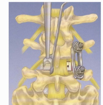PLIF and TLIF: Effective Lumbar Fusion for Lasting Relief
