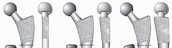 Illustration of doubletapered primary stems - Dr. Mohammed Hutaif