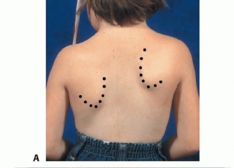 Illustration of elevation of the scapula - Dr. Mohammed Hutaif