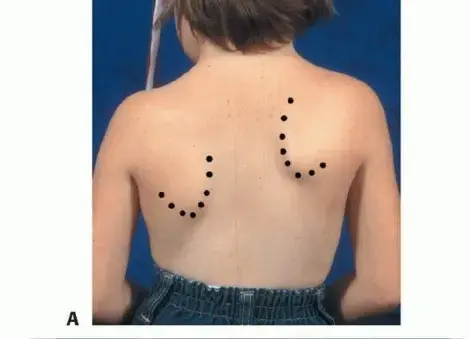 صورة توضيحية لـ تشوه سبرينغل: دليلك الشامل للعلاج مع الأستاذ الدكتور محمد هطيف