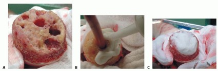 صورة طبية: ترميم مفصل الورك: الحل الأمثل للحفاظ على عظم رأس الفخذ في صنعاء مع الدكتور محمد هطيف