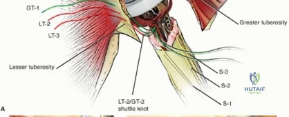 Open Reduction of Subtalar Dislocation: A Comprehensive Surgical Guide
