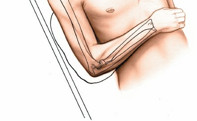 Illustration 57 for Mastering Approaches to the Upper Third of the Radius