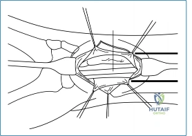 Mastering Wrist Surgery: Actions That Must Be Taken for Success