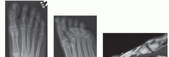 Surgical Strategies for Freiberg: Alleviating Dorsal Metatarsal Head Pain