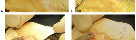 Illustration 27 for Plantar Plate Repair: End Lesser Toe Pain & Instability