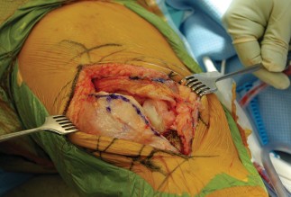 Illustration 12 for Optimize Tibial Component Alignment: Techniques for TKA Success
