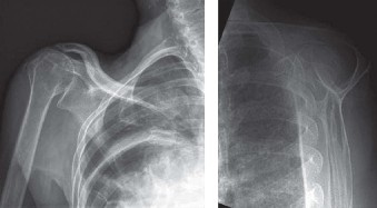 Illustration 5 for Irreparable Rotator Cuff Tears: What Are Your Treatment Options?