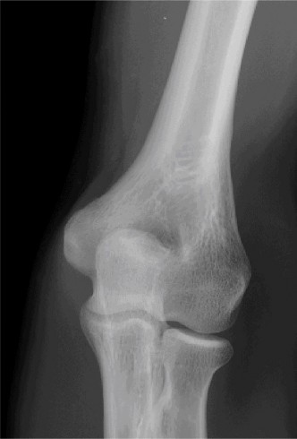 Illustration 65 for Right Shoulder Pain? Avoid This Common X-ray Mistake.