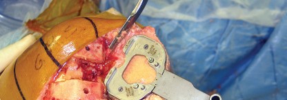 Illustration 31 for Minimize Pain, Maximize Recovery: TKA with Parapatellar