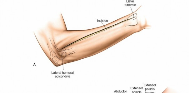Illustration 101 for Mastering Approaches to the Upper Third of the Radius
