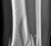 Decoding Pilon Fractures: Anterolateral and Medial Fragments Revealed