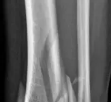 صورة توضيحية لـ كسور البيلون المعقدة: دليل شامل للعلاج والتعافي مع الأستاذ الدكتور محمد هطيف في صنعاء