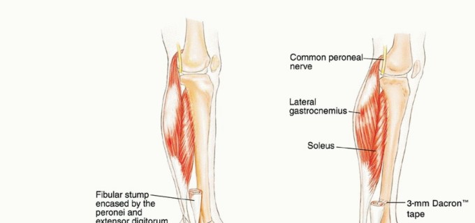 صورة طبية: استئصال أورام الشظية: دليل شامل للعلاج الحديث والحفاظ على الأطراف مع الأستاذ الدكتور محمد هطيف