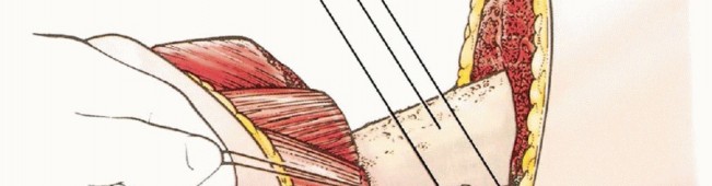 صورة طبية: استئصال نصف الحوض بالرفرفة الأمامية: حلول متقدمة لأورام الحوض الصعبة مع الأستاذ الدكتور محمد هطيف في صنعاء