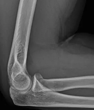 صورة توضيحية لـ تيبس مفصل الكوع بعد الإصابات: تشخيص وعلاج التعظم المغاير مع الأستاذ الدكتور محمد هطيف