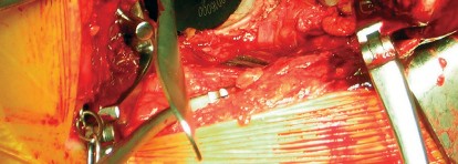 صورة طبية: طول عمر مكون الحُق الأسمنتي في مفصل الورك: مفتاح الاستقرار والديمومة مع الأستاذ الدكتور محمد هطيف في صنعاء